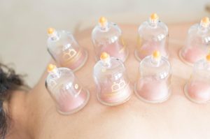 Cupping therapie behandeling met zuignappen voor chronische aandoeningen en pijnverlichting